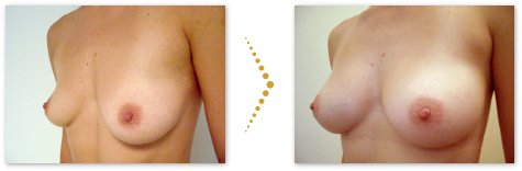 Patientin vor und nach der Brustvergrößerung mit Stammzellen