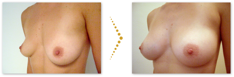 Patient before and after stem cell breast augmentation