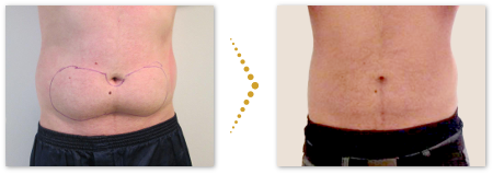 Patient before and after treatment with fat-away injection