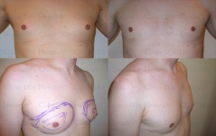 Gynecomastia (Pseudogynecomastia) in men