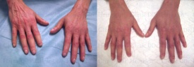 Stem cell skin rejuvenation on the hands