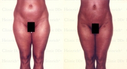 Microcannular liposuction on belly, hips, and outer thighs