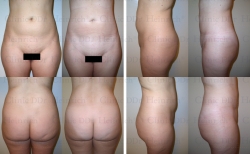 Microcannular liposuction on waist, upper belly, lower belly, and hips