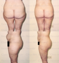 Microcannular liposuction on belly, buttocks, and outer thighs