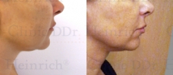 Microcannular liposuction on the chin