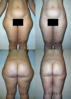 Microcannular liposuction on hips, buttocks, outer thighs, and inner thighs