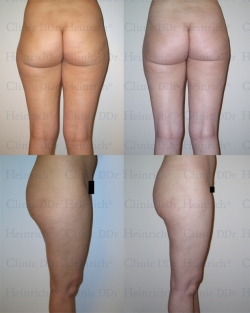 Microcannular liposuction on outer thighs