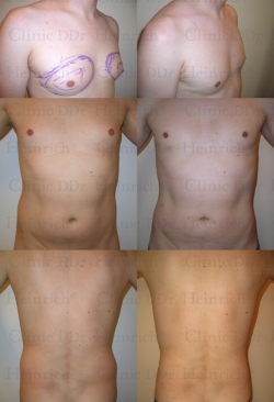 Microcannular liposuction on breast, belly, and buttocks