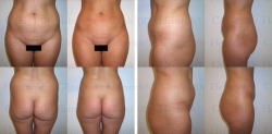 Microcannular liposuction on lower belly and hips