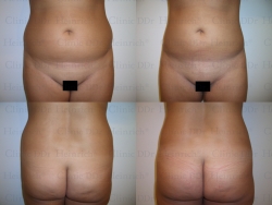 Microcannular liposuction on upper belly, lower belly, back, hips, buttocks, and outer thighs