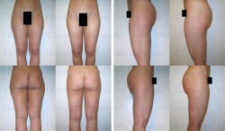 ddrheinrich-liposuction-26Microcannular liposuction on hips, buttocks, outer thighs, and inner thighs