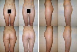 Microcannular liposuction on buttocks, outer thighs, and inner thighs