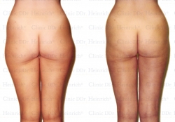 Microcannular liposuction on outer thighs