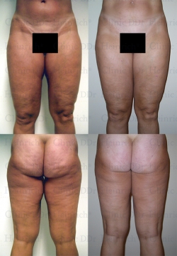 Microcannular liposuction on buttocks, outer thighs, inner thighs, and knees