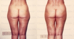 Microcannular liposuction on outer thighs