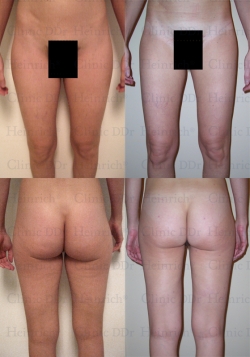 Microcannular liposuction on hips, buttocks, outer thighs, and inner thighs