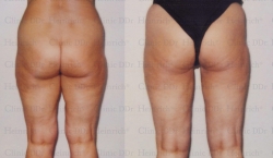 Microcannular liposuction on outer thighs, inner thighs, and knees