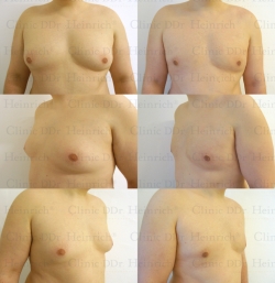 Microcannular liposuction on the breast