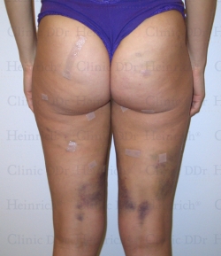 Patient one day after microcannular liposuction